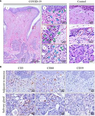 Severe acute respiratory syndrome coronavirus 2 pathology and cell tropism in tongue tissues of COVID-19 autopsies